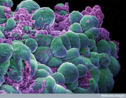 Celulele cancerului de sân