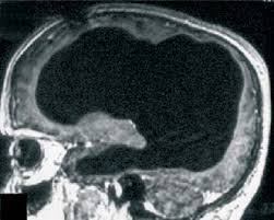 Radiografia craniană a omului fără 90 la sută din creier