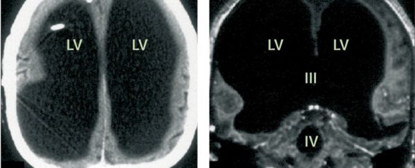 Radiografie craniană
